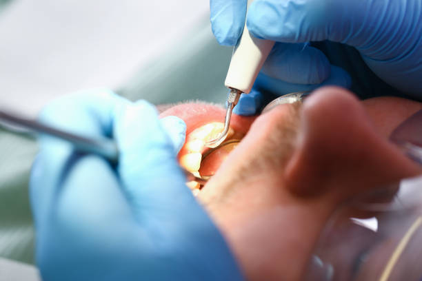 Best Emergency Treatment for Dental Infections or Abscesses in Twentynine Palms, CA